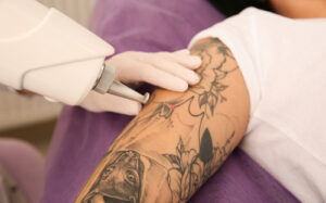 Indepartare laser