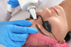 Indepartare laser