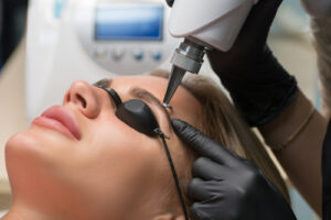 Indepartare laser